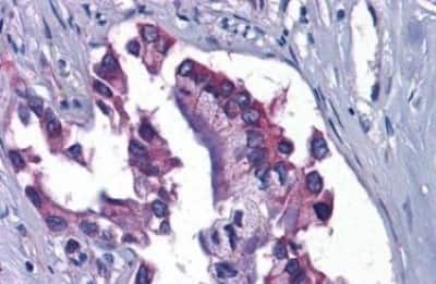 Immunohistochemistry-Paraffin: GFPT1 Antibody [NBP3-14334] - GFPT1 antibody IHC of human Pancreas, Carcinoma. Immunohistochemistry of formalin-fixed, paraffin-embedded tissue after heat-induced antigen retrieval.